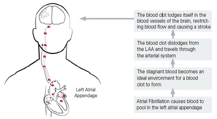Diagram explaining left atrial appendage.