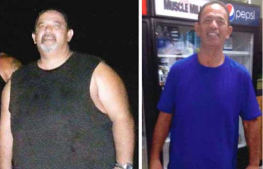 Frank Before and After Gastric Bypass Surgery