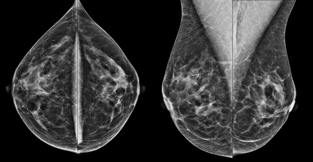 Mammography scans